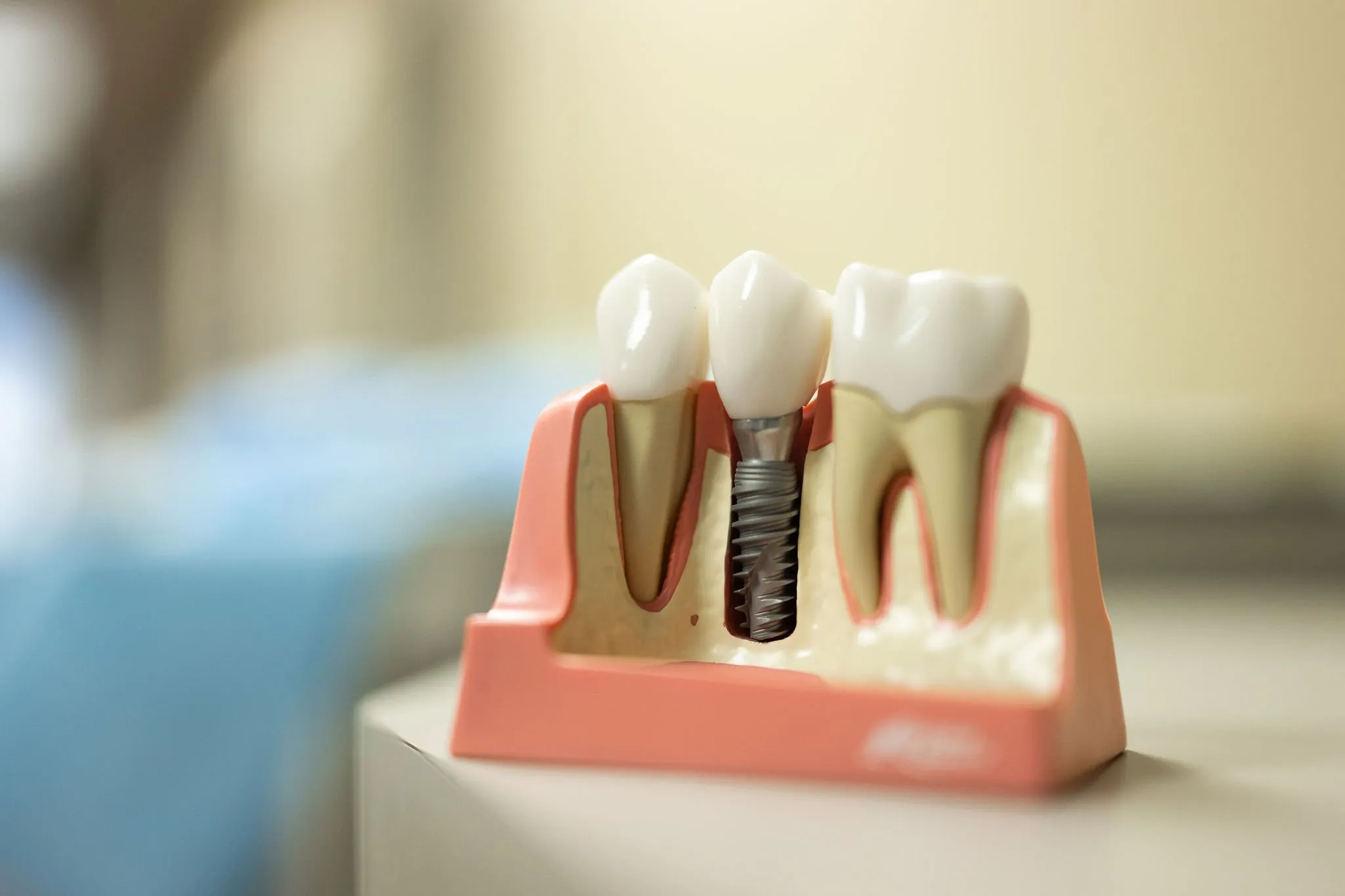 Dental Implants | Lake Norman Oral & Facial Surgery, Huntersville, NC
