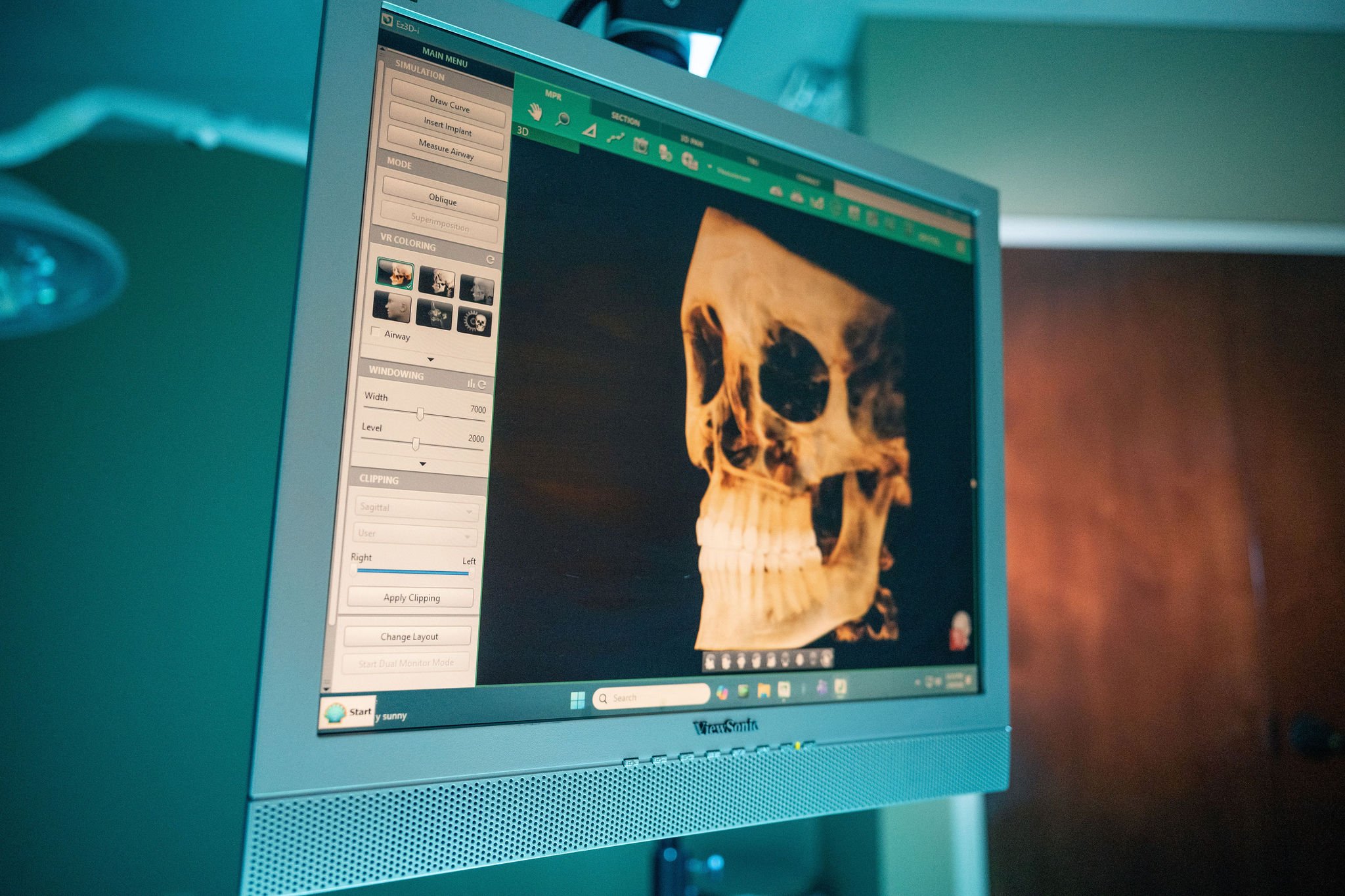 Wisdom Teeth Extraction | Lake Norman Oral & Facial Surgery, Huntersville, NC